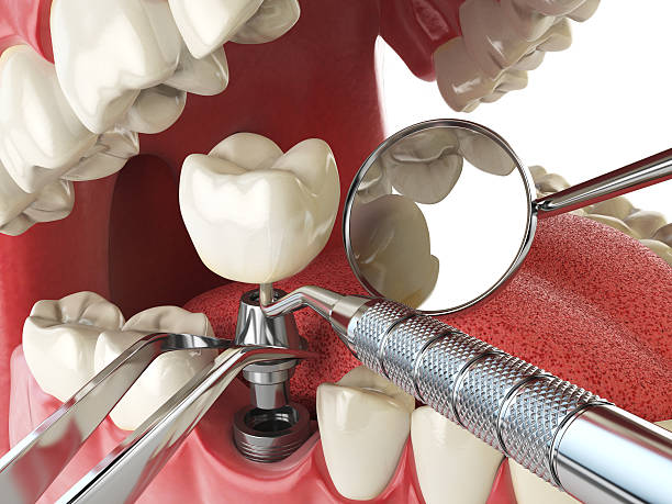 Best Broken or Chipped Tooth Repair in Chillicothe, MO